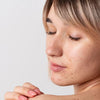5 Ways to worsen your acne in winter season